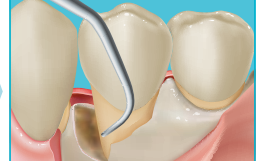 歯周手術のイラスト