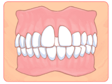 すきっ歯のイラスト
